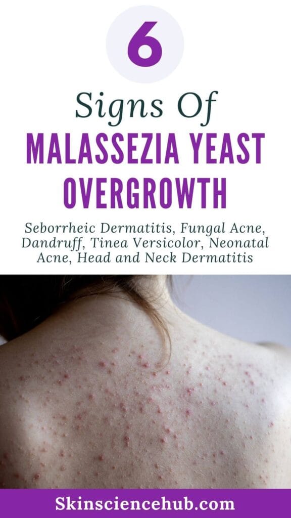 6 Signs of Malassezia Yeast Overgrowth (Seborrheic Dermatitis, Fungal Acne, Dandruff, Tinea Versicolor, Neonatal Acne, Head and Neck Dermatitis)