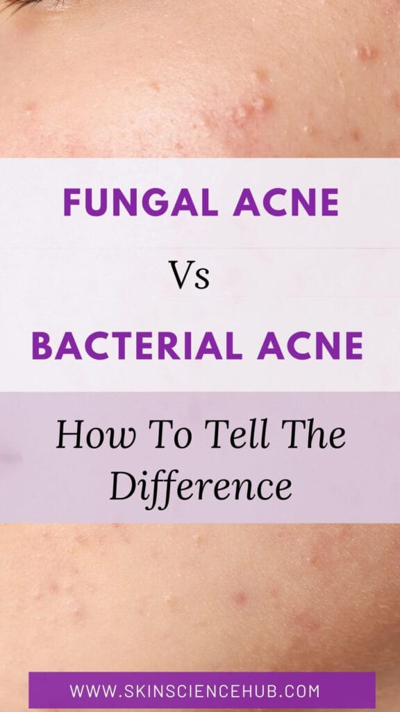 Fungal Acne vs Bacterial Acne? How to Tell & Treat It