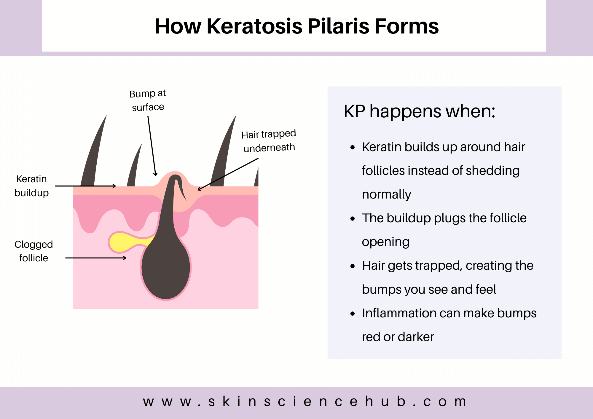 Keratosis Pilaris on Face: Treatments, Causes and What to Avoid