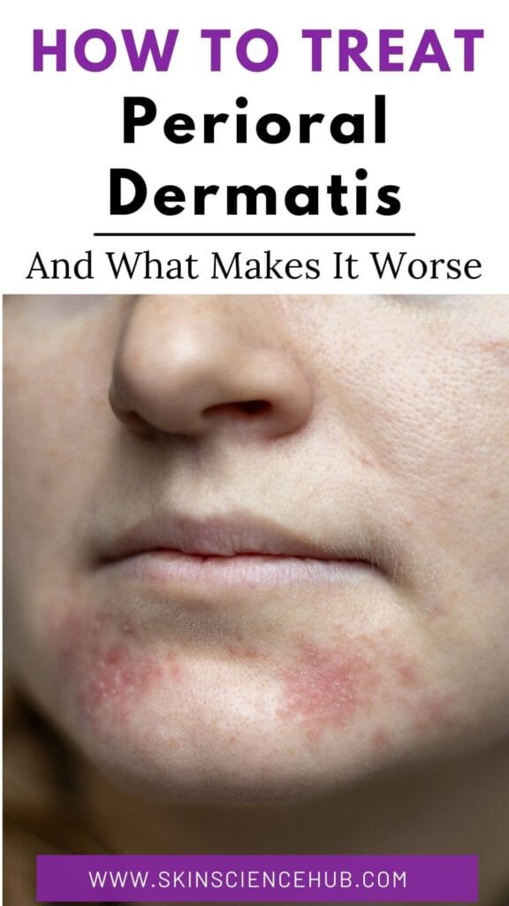 How to Treat Perioral Dermatitis and What Makes It Worse