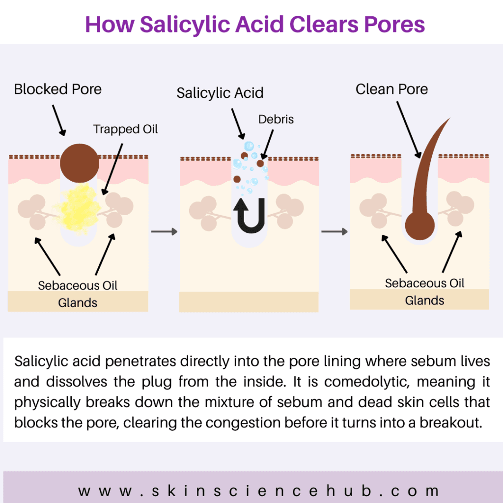 How Salicylic Acid clears pores and Treats Acne