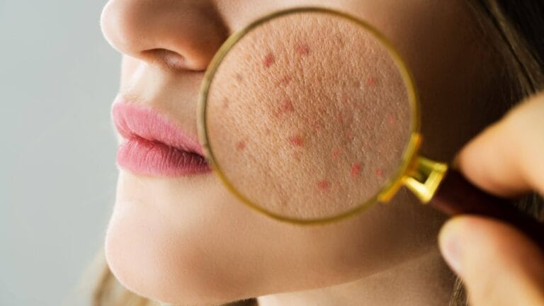 skin barrier damage (1)