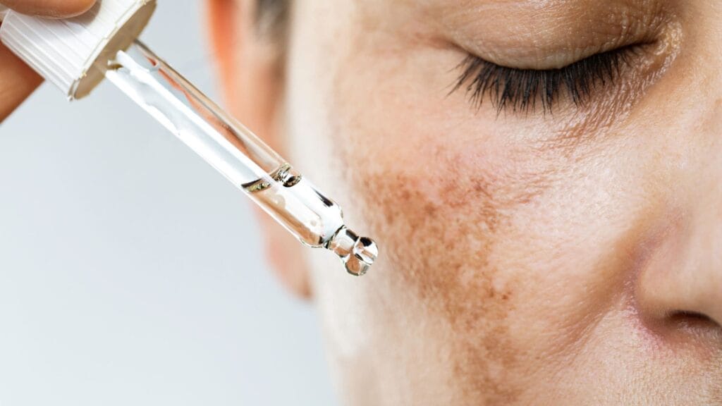 Azelaic acid for hyperpigmentation, melasma and PIH