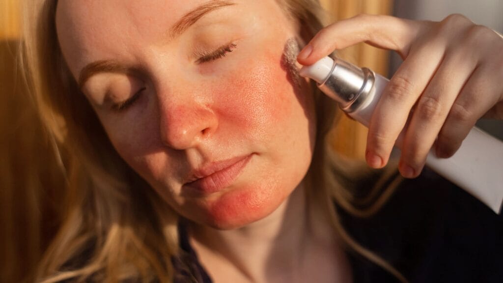 azelaic acid for rosacea