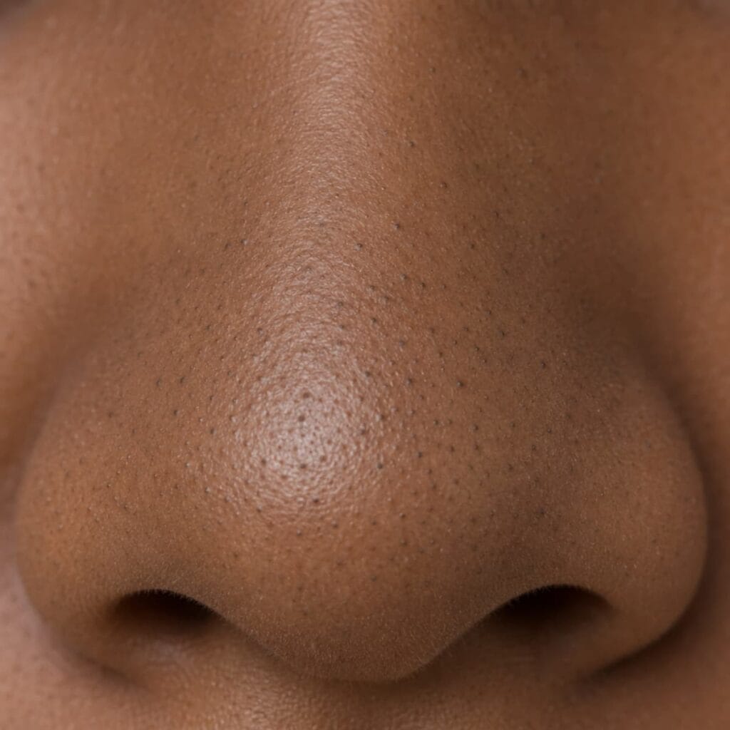 Blackhead on deep skin, a dark clogged pore caused by oxidized melanin
