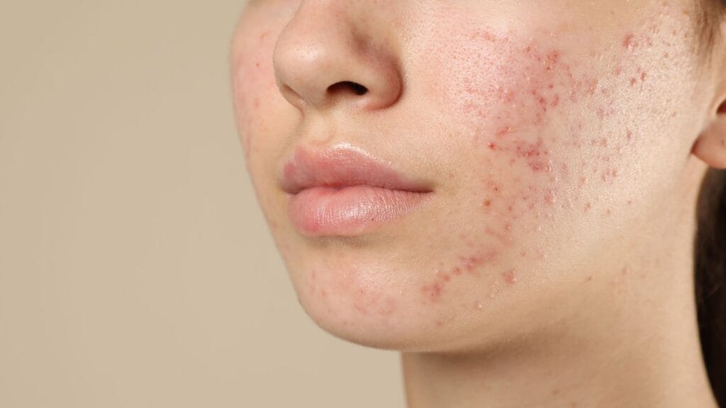 Close-up of a woman's jawline showing mild acne, including blackheads and papules