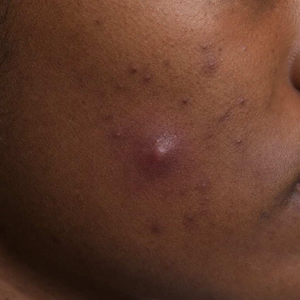 Acne cyst on deep skin, a large soft fluid-filled bump under the skin