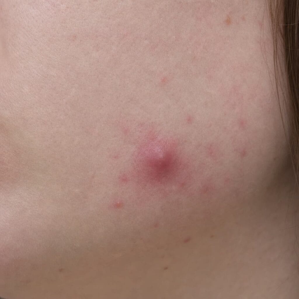 Acne cyst on fair skin, a large soft fluid-filled bump under the skin