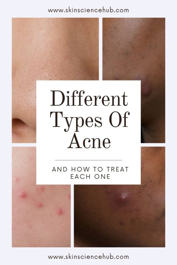 Different Types of Acne (With Pictures) and How to Treat Each One