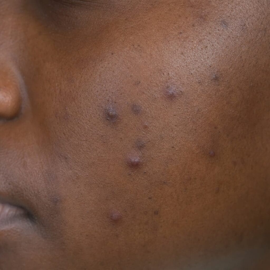 Acne papule on deep skin, an inflamed bump with no visible center