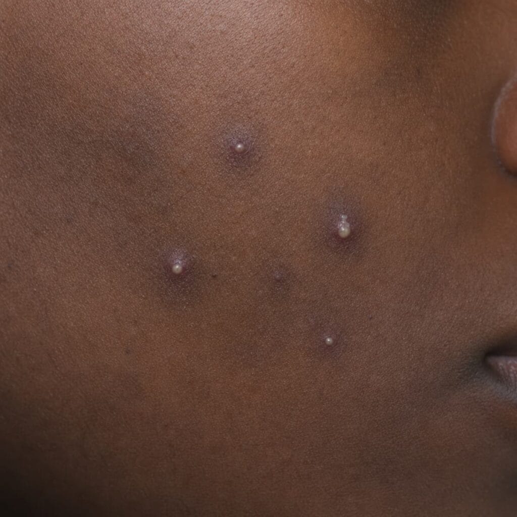 Acne pustule on deep skin, an inflamed bump with a white pus-filled center