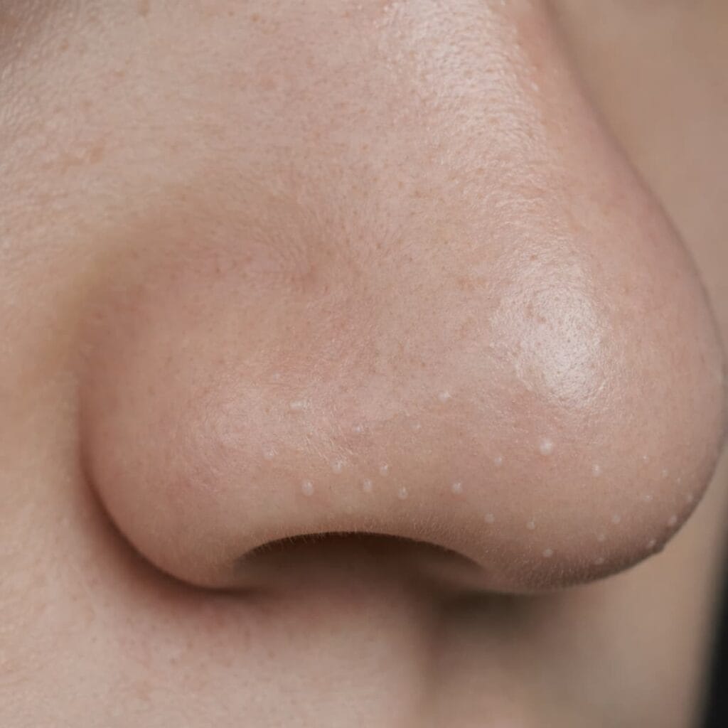 Whitehead on fair skin, a small closed bump with no dark center