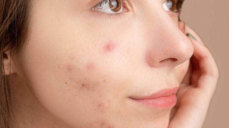 Skin purging vs breakout comparison showing purging spots concentrated in typical acne-prone areas and breakout spots appearing somewhere new