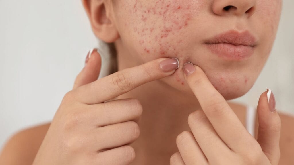 woman with hormonal acne on chin and jawline