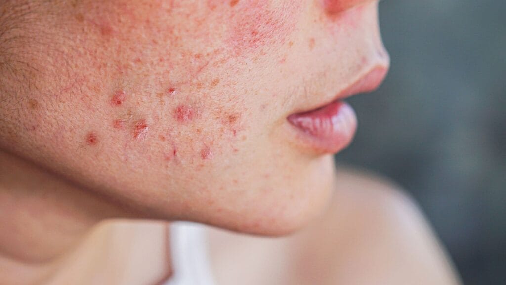 Post-inflammatory erythema (PIE) causing red marks on lighter skin tone