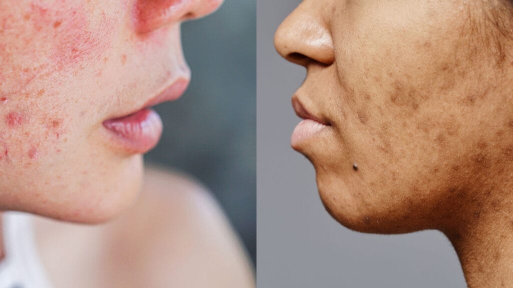 "Post-inflammatory erythema (PIE) red marks on lighter skin next to post-inflammatory hyperpigmentation (PIH) brown marks on deeper skin tone