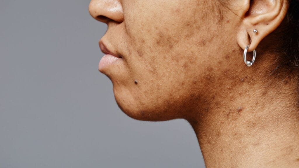 Post-inflammatory hyperpigmentation (PIH) causing brown marks on deeper skin tone
