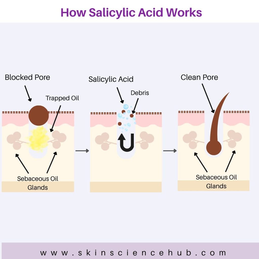How Salicylic Acid Works