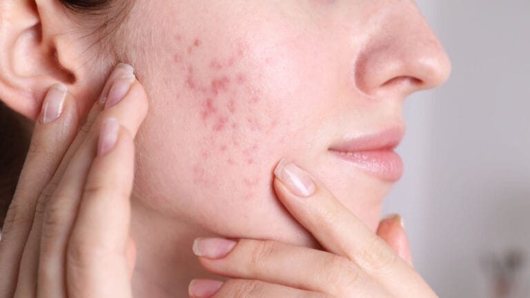 Congrats, You’ve Been Treating a Fungal Infection Like It’s Acne