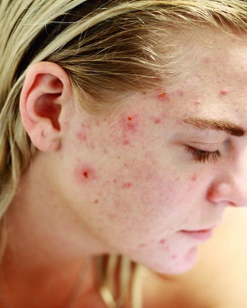 Acne and breakouts