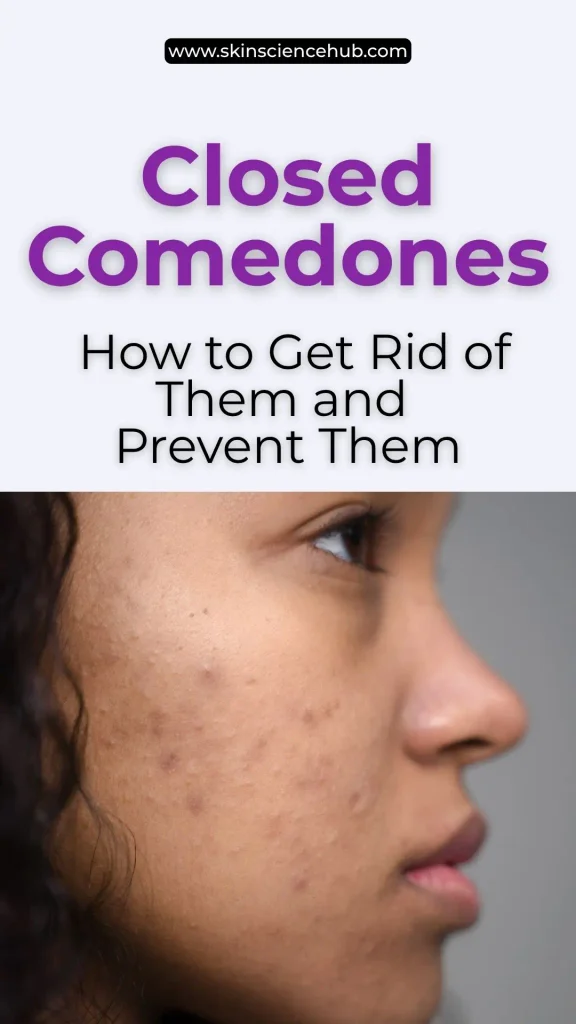 Closed Comedones: How to Get Rid of Them and Prevent Them