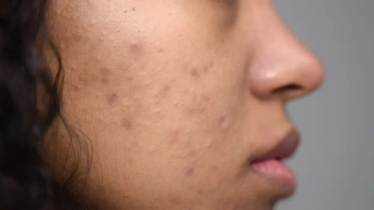 Close-up of closed comedones on the cheek, showing small, skin-colored bumps on darker skin